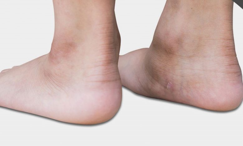 برای درمان کف پای صاف به چه دکتری باید مراجعه کرد؟
